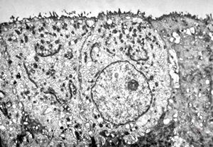 M,18y. | immotile cilia syndrome - bronchus M,18y. | immotile cilia syndrome - bronchus
